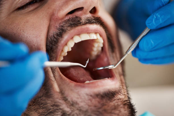 Best Emergency Tooth Extraction in Charlack, MO