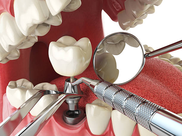 Best Emergency Treatment for Dental Infections or Abscesses in Charlack, MO